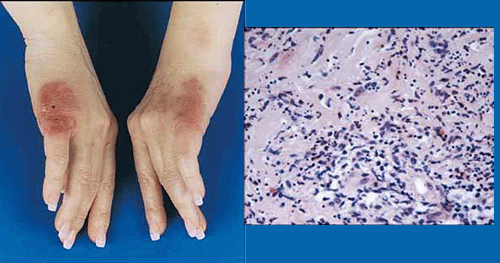 neutrophilic dermatitis image